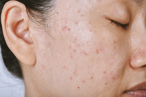 Acne Scare Treatment With CO laser Taj Skin Hair Laser Clinic Kothrud Warje