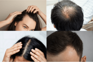 Hairloss Treatment at Taj Skin hair Laser clinic 300x200 - Laser Hair Removal, Facial, Acne, Tattoo Treatments in Kothrud, Warje