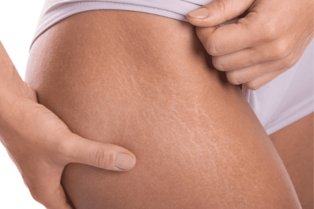 Stretch Marks Removal Treatments Taj Skin Hair Laser Clinic Kothrud Warje