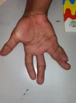 finger displacement 1 111x150 - Orthopaedic Doctor in Kothrud | Orthopaedic Surgeon in Kothrud | Dr. Sunny Dole